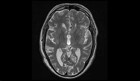 mri slice thickness test|slice selection in mri.